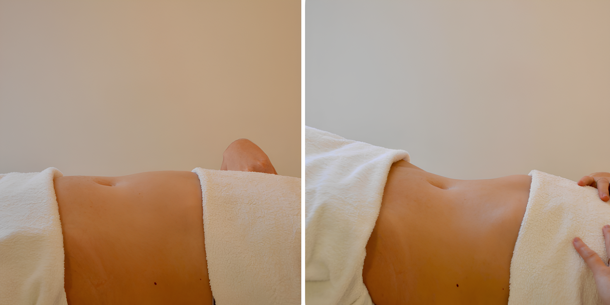 Résultat d’un remodelage du ventre : comparaison avant-après montrant une silhouette affinée et tonifiée.