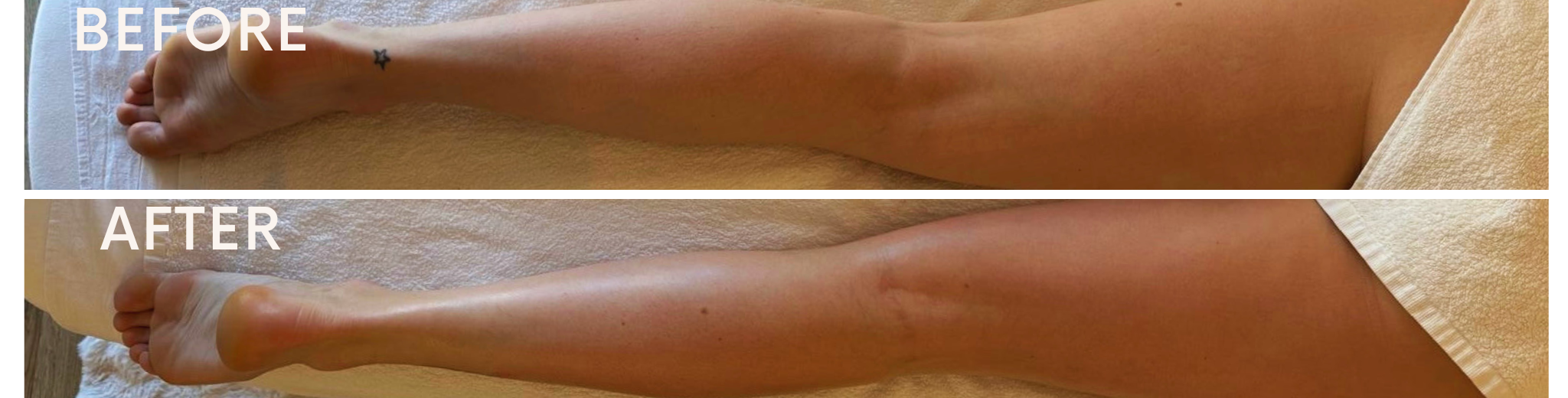 Photo avant/après d'une jambe drainée